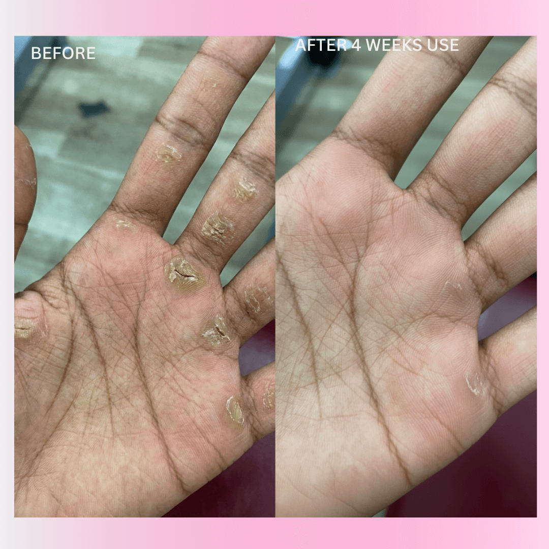 GripHer™ PalmShield